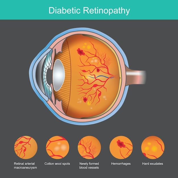 How Diabetes Can Damage Your Eyes: A Guide to Diabetic Retinopathy